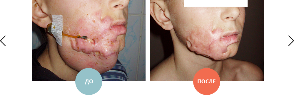 удаление рубцовой деформации лица методом растягивания тканей (дермотензия)