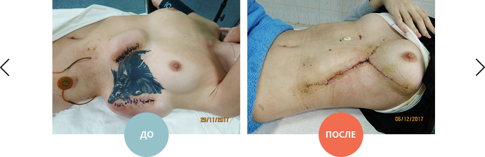 удаление татуировки методом растягивания тканей (дермотензия)