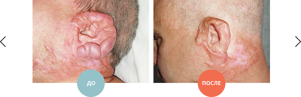 лечение келоидного послеожогового рубца ушной раковины методом свободной аутодермопластики