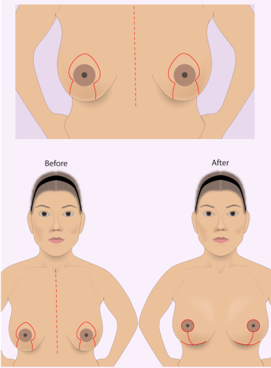 Женская грудь. Разновидности и формы.