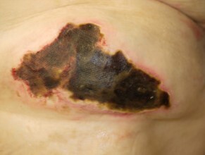 Трофическая язва на коже – симптомы, причины, признаки, диагностика и лечение в «СМ-Клиника»