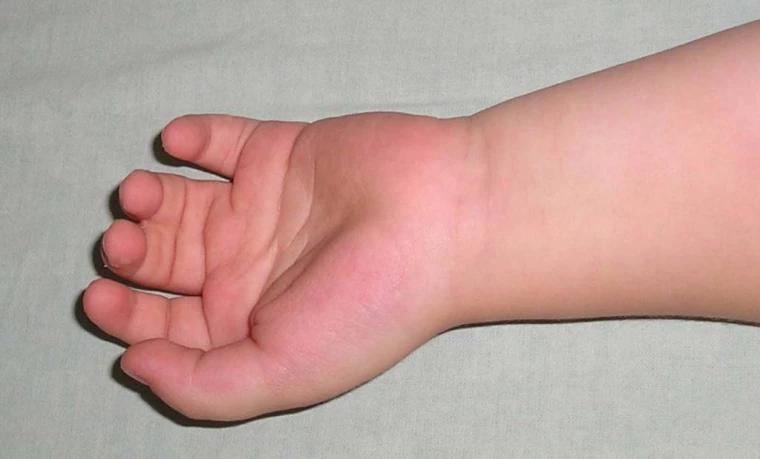 Трьохфалангізм першого пальця кисті у дітей