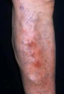 Інфекції шкіри та м'яких тканин у ін'єкційних наркоманів - симптоми та лікування