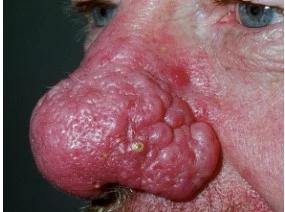 Ринофіма носа - симптоми та лікування