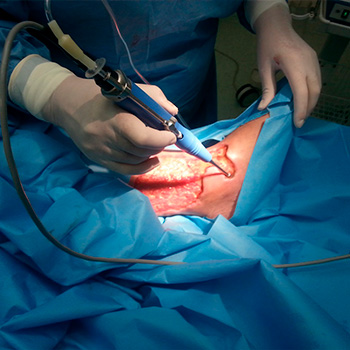 Хирургическая обработка инфицированной стопы